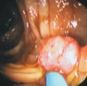 Understanding Prostate Cancer