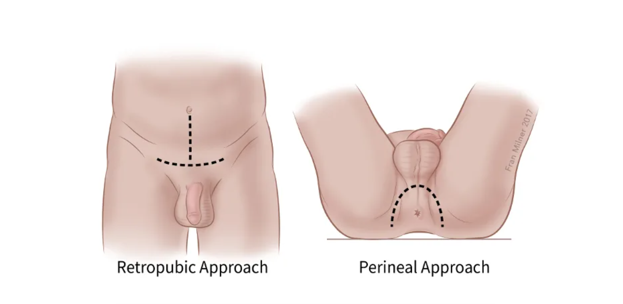 Medical Expert Advocates Early Screening to Combat Rising Prostate Cancer Cases in Nigeria