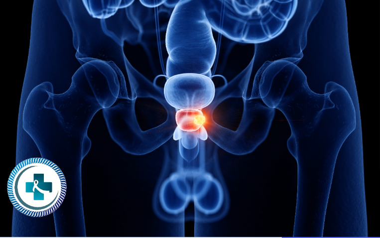 A Turning Point in Cancer Care in West Africa: The Promise of SBRT